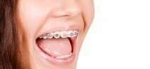 COMMENT SE DEROULE LE TRAITEMENT ORTHODONTIQUE ? - DR BODIN, DENTISTE A ANTIBES