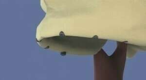 Maxillaire all on six et comblement de sinus