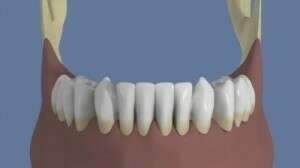 Mandibule : Bridge complet scellé sans fausse gencive