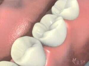 Couronne sur implant dentaire