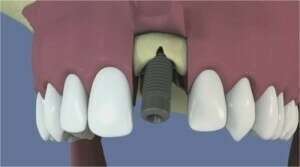 Extraction, implantation et mise en esthétique immédiate
