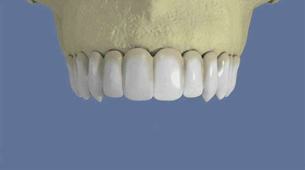 Maxillaire : bridge vissé sans fausse gencive