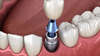 Les implants