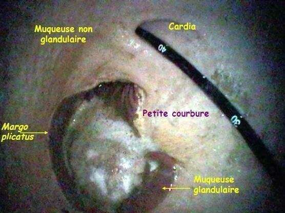 Gastroscopie