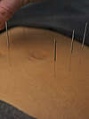 Acupuncture