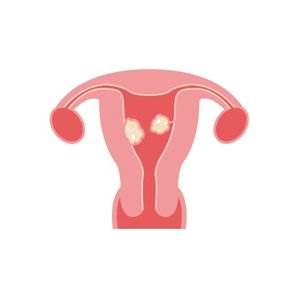 Fibromes utérins et alimentation : que peut proposer la MTC ?