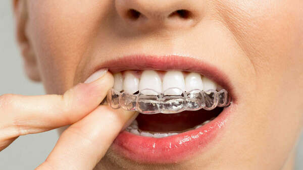 L'ORTHODONTIE INVISIBLE