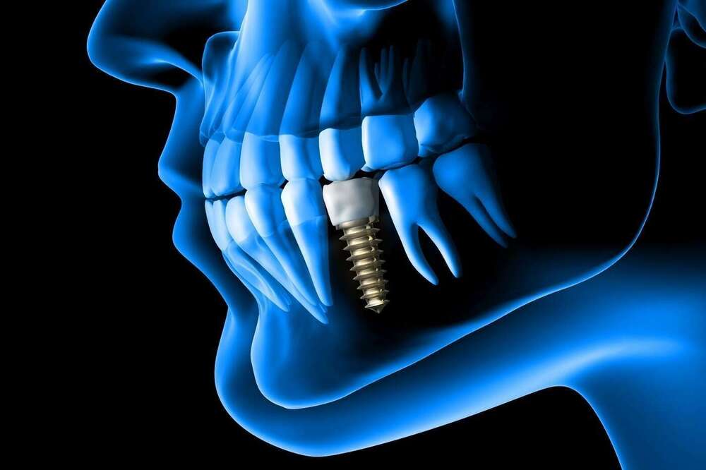 Qu'est-ce qu'un implant ? indications et contre-indications