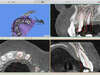 Simulateur de pose implants dentaire