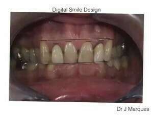 Cas de Digital Smile Design