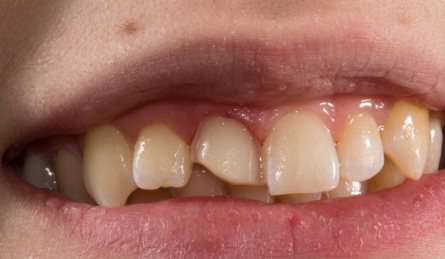 CAS CLINIQUE - FACETTES