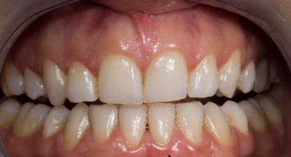 CAS CLINIQUES - BLANCHIMENT