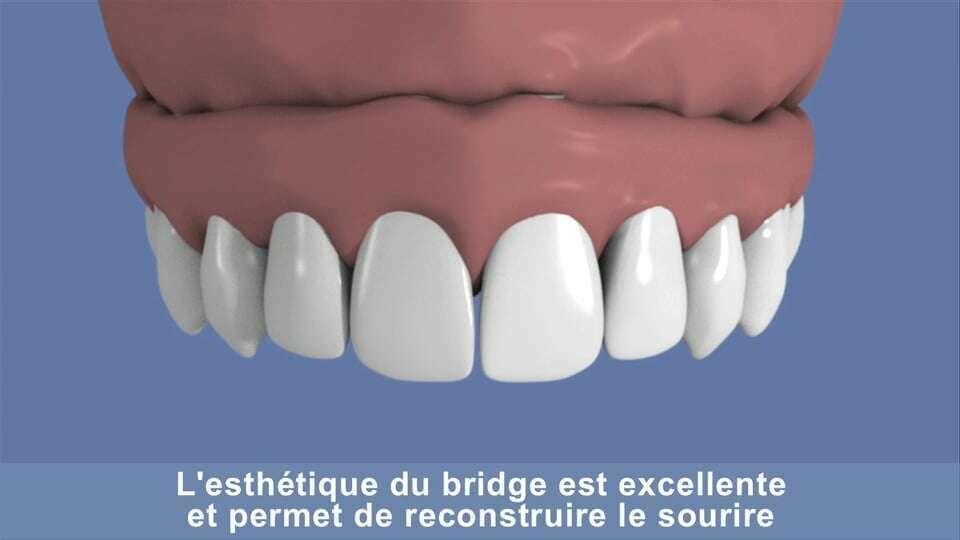 Maxillaire complet et traitement implantaire pour un bridge fixe scellé