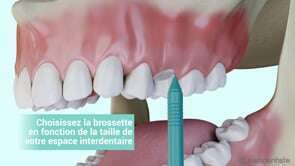 Comment bien utiliser la brossette interdentaire ?