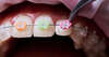 femme adolescente souriante avec bagues orthodontiques visibles