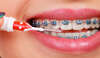 femme adolescente souriante avec bagues orthodontiques visibles