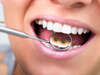 Orthodontie linguale à Nogent sur Marne - Dr Goure-Hervier