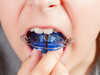 Orthodontie interceptive : enfant mettant en place un appareil amovible