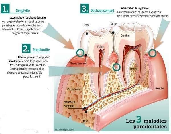 Soins Parodontaux Bonnieux Soins Parodontaux Bonnieux
