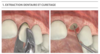 Extraction dentaire et curetage