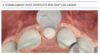 Comblement avec Geistlich Bio-Oss Collagen