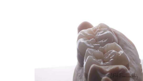 Les restaurations céramiques ou Inlays Onlays