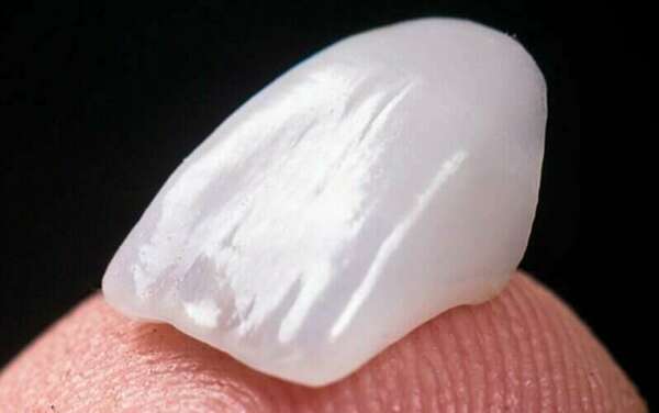 Les facettes dentaires