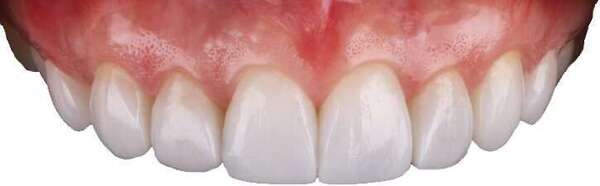 Les couronnes tout céramique