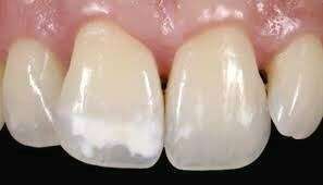 Les tâches blanches