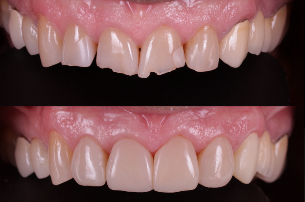 Composite injecté
