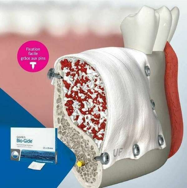 Régénération osseuse - Sinuslift