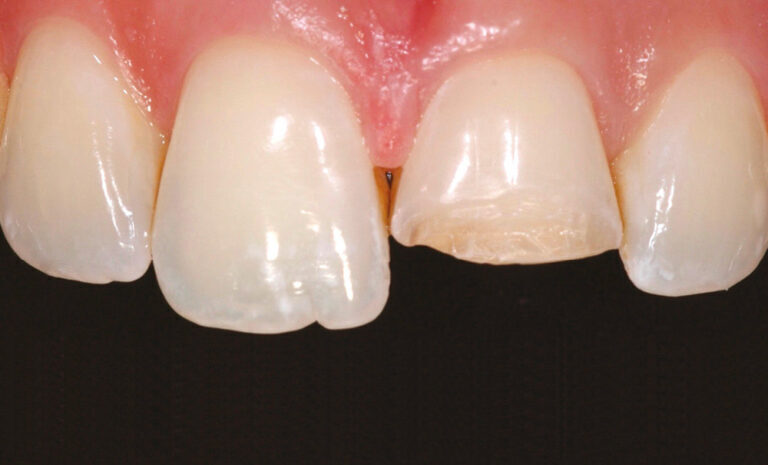 Composites stratifiés