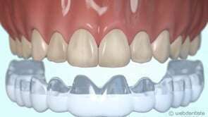 Eclaircissement ambulatoire