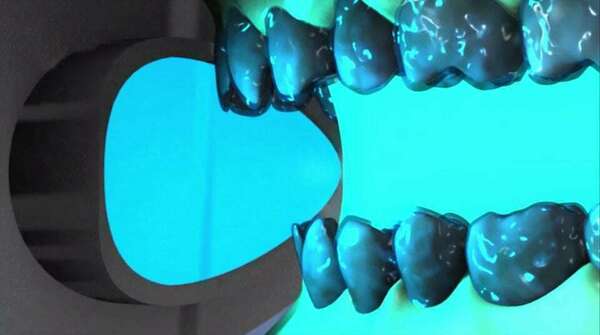 Blanchiment au fauteuil