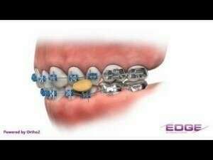 Les aliments à éviter avec un appareil dentaire