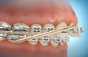 Elastique inter maxillaire de classe II