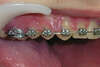 Fil orthodontique trop long dépassant à l'arrière de la bague