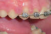 Fil orthodontique trop long dépassant à l'arrière du bracket