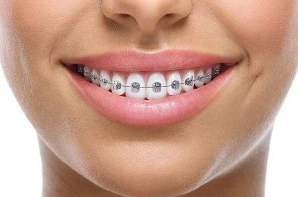 L'orthodontie multibagues en métal