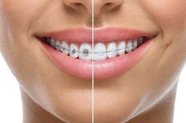 L'orthodontie multibagues en céramique