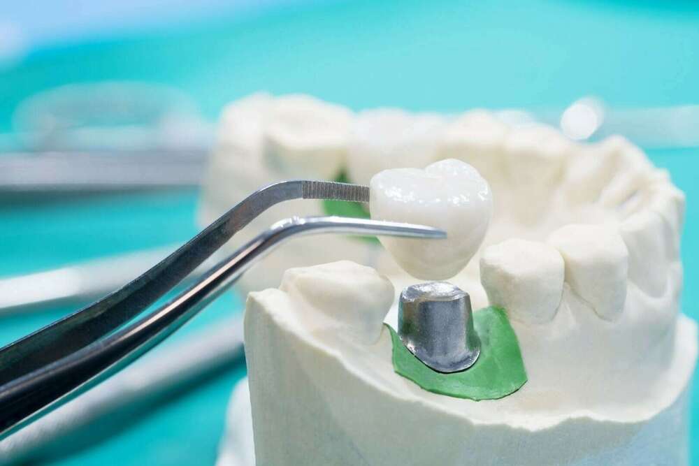 TARIFICATION DES ACTES DE SOINS DENTAIRES ET IMPLANTAIRES