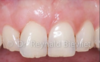 greffe gingivale après