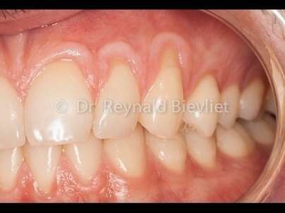 Greffe gingivale avant