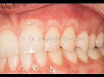 Greffe gingivale après