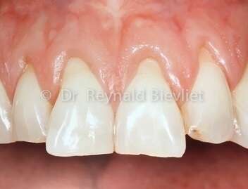 Greffe gingivale avant