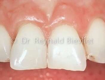 Greffe gingivale après