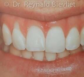 Greffe gingivale avant