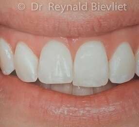 Greffe gingivale après