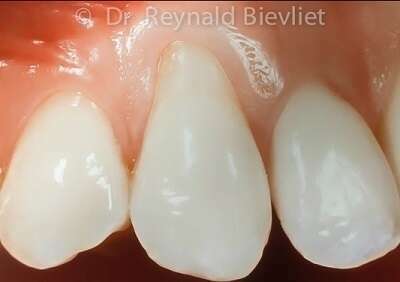 Greffe gingivale avant