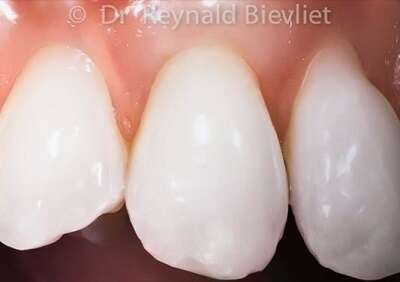 Greffe gingivale après